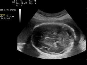 Pregnancy_ultrasound
