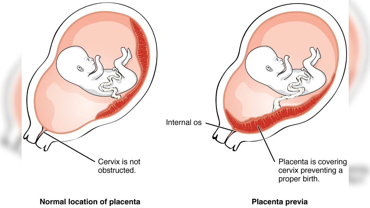 Internal OS Closed What Does It Mean in Pregnancy Scan Report