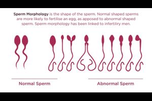 Sperm Analysis Test