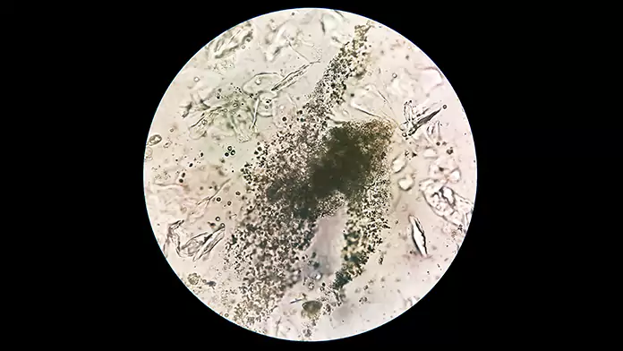 epithelial cells in urine during pregnancy