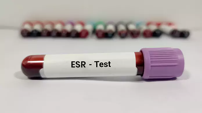 ESR Test During Pregnancy
